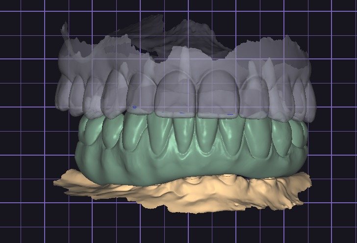 Full-arch design with transparent upper arch, frontal view