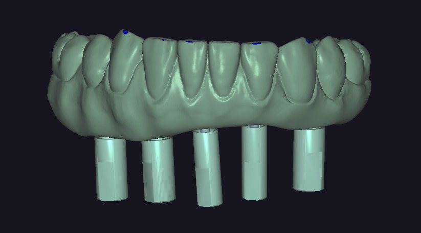 Full-arch prosthesis design with five implant connections