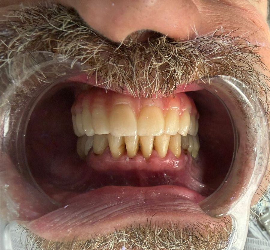 Final result in the mouth, frontal view