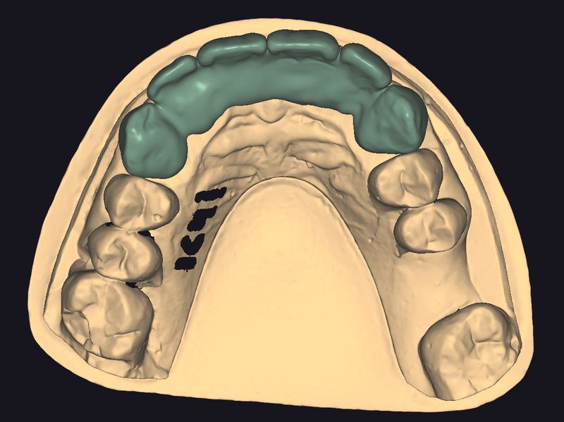 CAD design of an anterior bridge, occlusal view