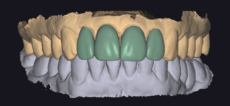 CAD design of four anterior crowns, frontal view