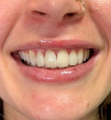 After: final anterior restoration