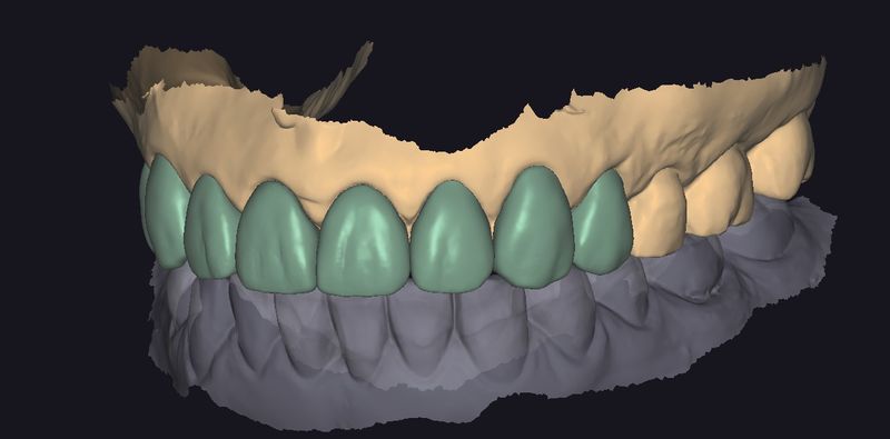 CAD design of the anterior restorations, oblique view