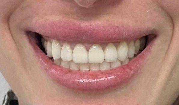After: final anterior restoration